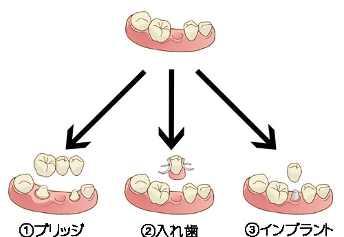 インプラント・入れ歯・差し歯って結局どれがいい