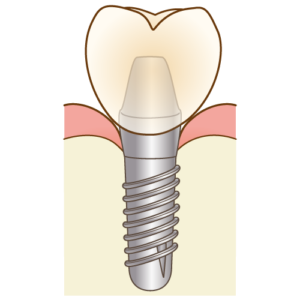 インプラントの寿命