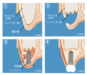 上顎洞底挙上術