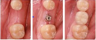 implant 1 インプラント手術後のセルフケア方法について