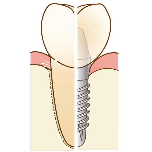 インプラント治療のデメリット