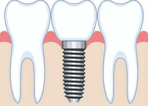 インプラントと歯周病