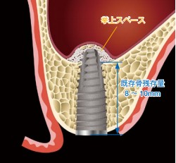ソケットリフト