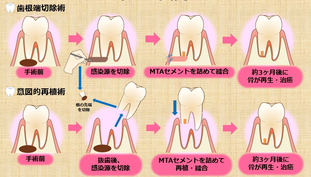 歯根端切除術と意図的再植術